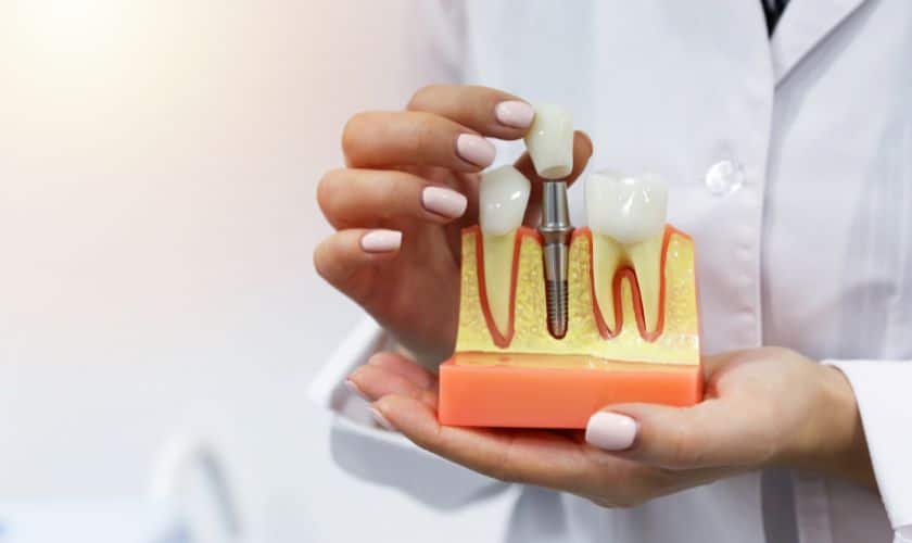 Featured image for “Understanding the Step-by-Step Process of Full Mouth Dental Implants”