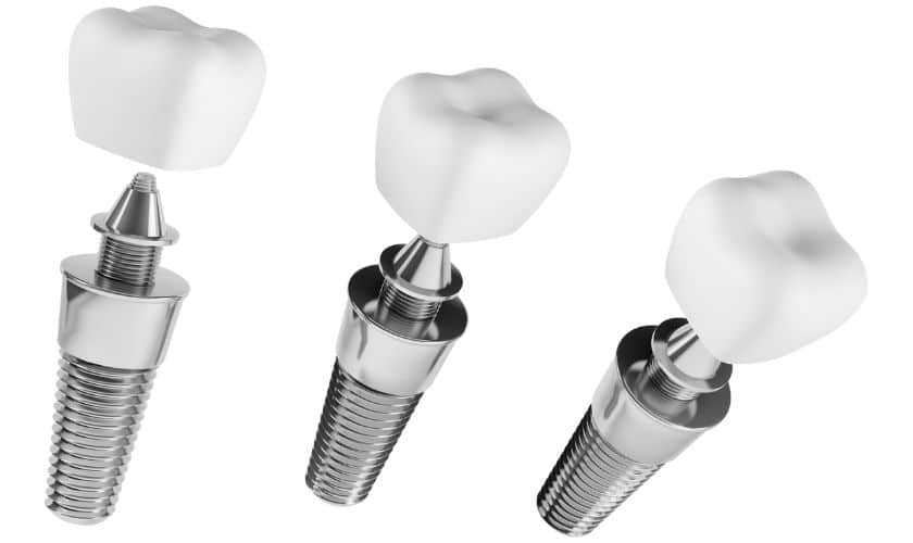 Featured image for “Are Dental Implants Right For You? Evaluating Candidacy In Austin”