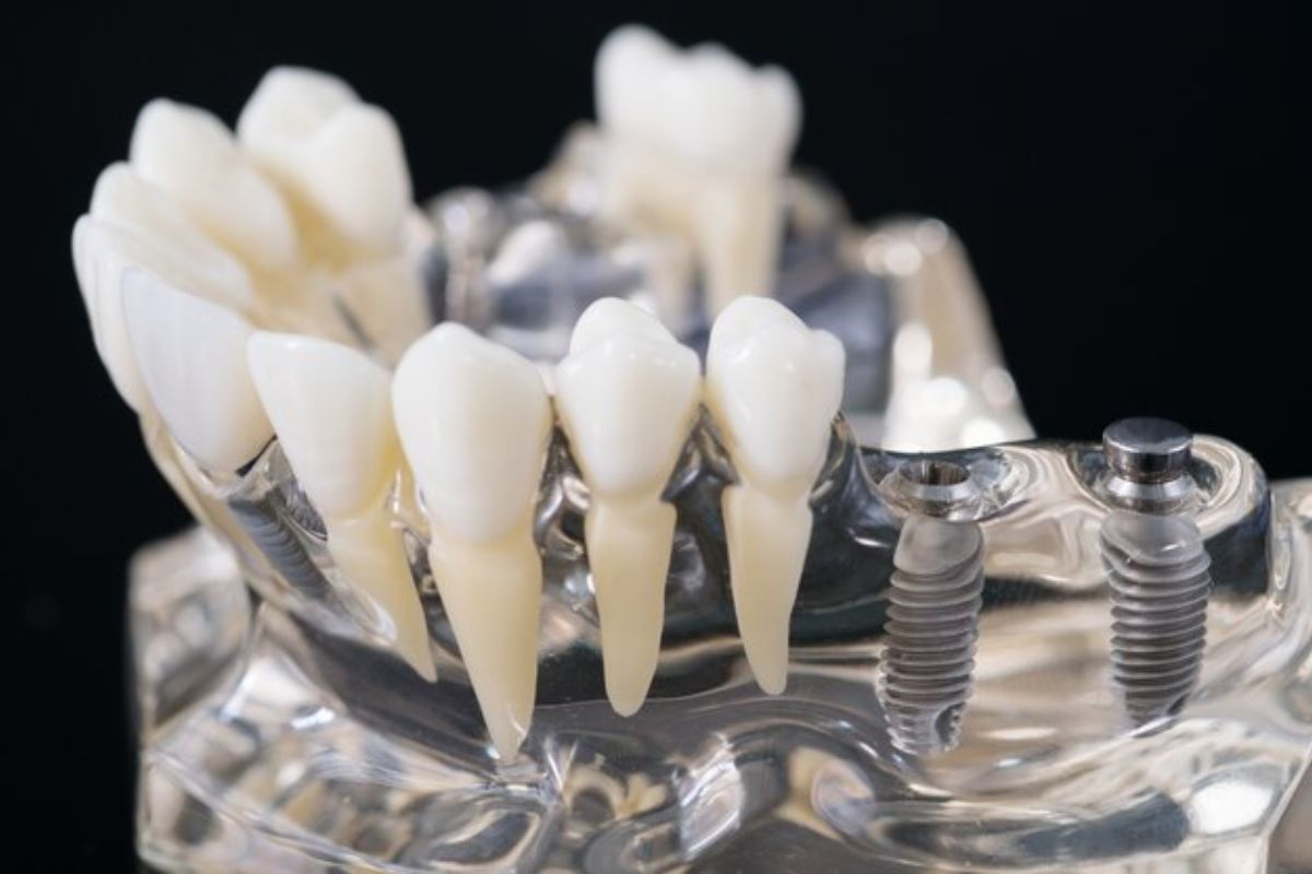 Featured image for “From Consultation to Completion: Your Dental Implant Journey in Austin”