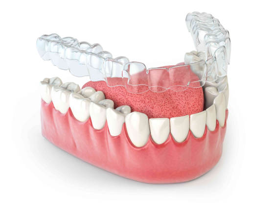 3D dental model showing teeth implant structure with transparent guides and pink gum base.