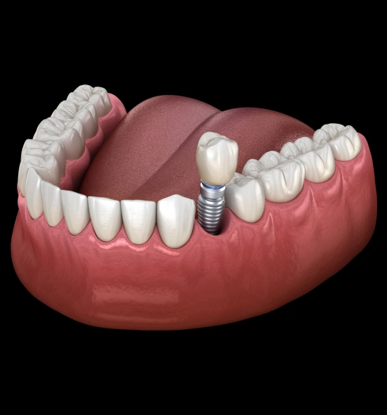 Featured image for “How Smoking And Diabetes Affect Dental Implant Success Rates In Austin”