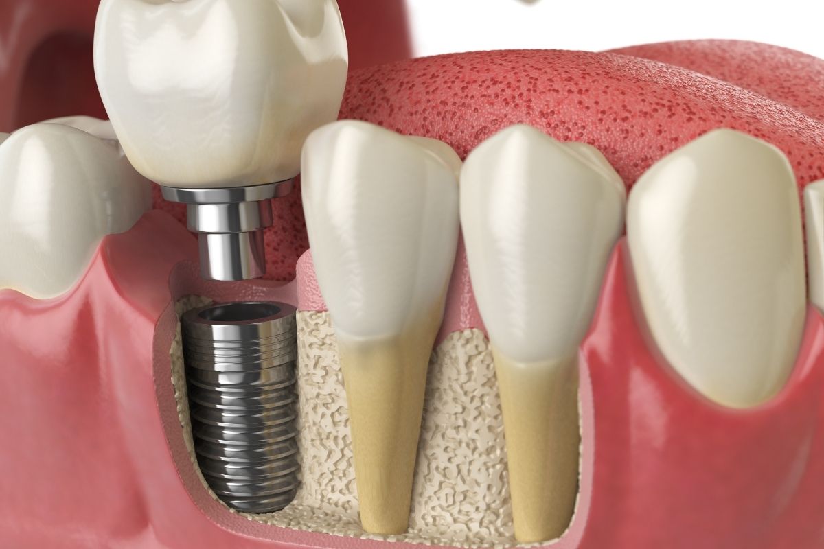 Featured image for “Why Delaying a Tooth Implant Can Lead to More Dental Problems”