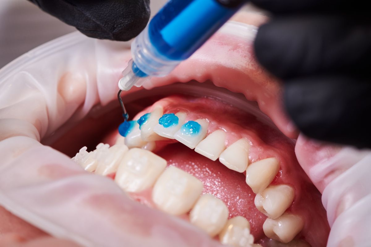 Featured image for “How to Fix Minor Smile Imperfections Without Braces”