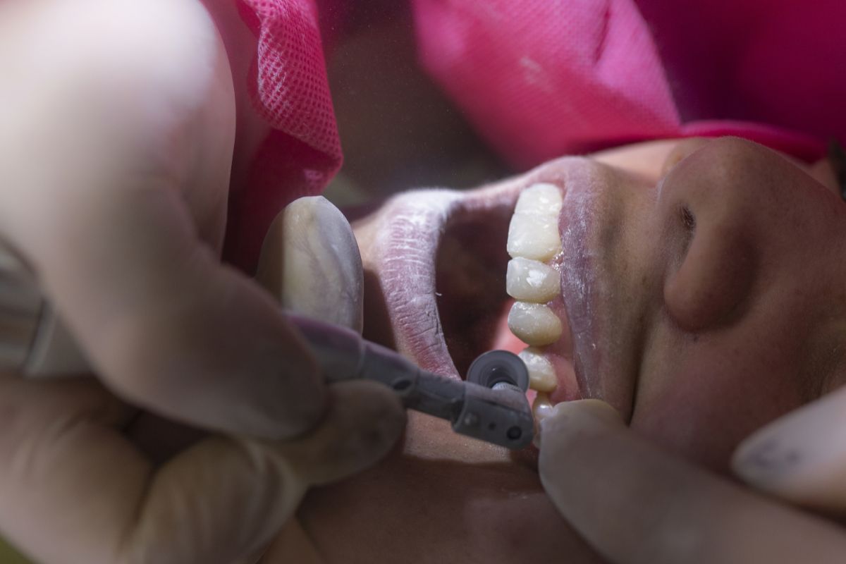 dental filling